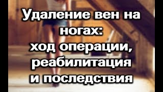 Операция при варикозе