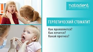 30. Острый герпетический стоматит у детей. Как лечить? 30. Острый герпетический стоматит у детей. Как лечить?
