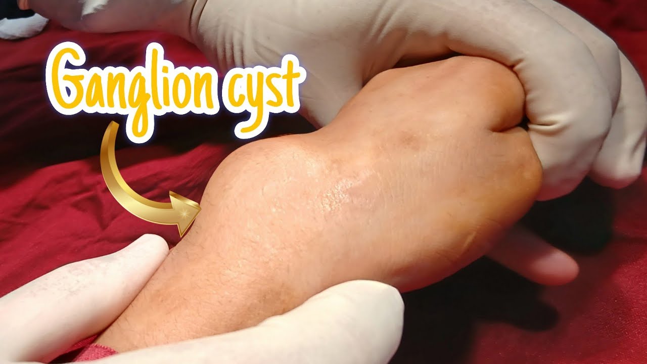 Complete Excision of Recurrent dorsal Ganglion cyst on the left wrist ...