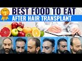 Hair Transplant in India | Best Results & cost of Hair Transplant in India