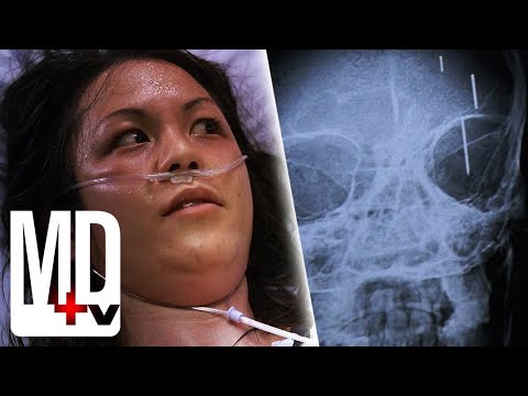 Poor Oral Hygiene Ends in Brain Infection | Chicago Med | MD TV