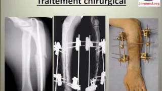 Fracture des deux os de l'avant bras - YouTube