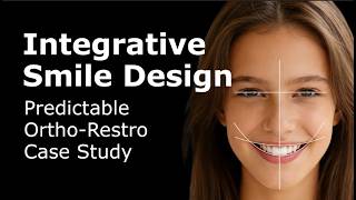 Integrative Smile Design | Predictable Ortho-Restro Case Study with TrioClear