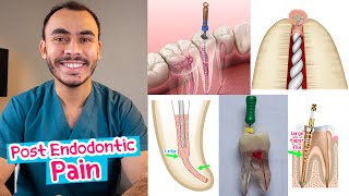 5 اسباب للـ Post Endodontic Pain