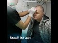مرحلة رسم خط الجبهة لعملية زراعة الشعر في مشفى بي أم أس كلينك 