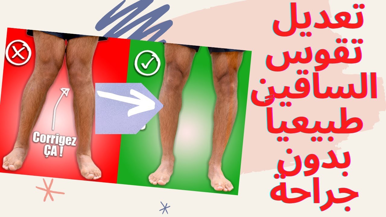 كيفية تعديل تقوس الساقين طبيعياً بدون جراحة
