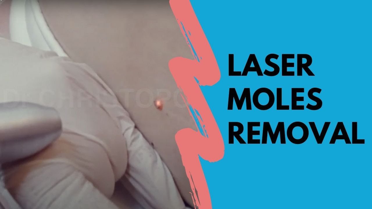 Moles Removal by LASER Plastic Surgeon YouTube