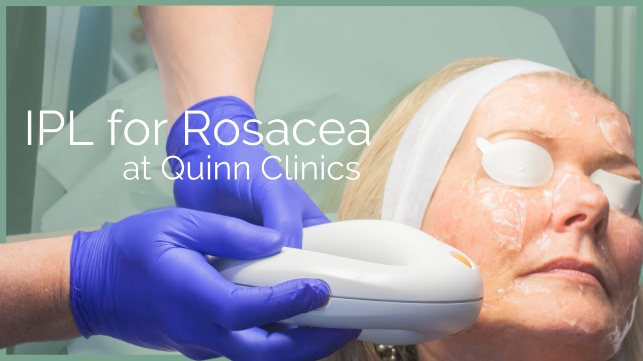 Intense Pulsed Light (IPL) on Sun Spots at Quinn Clinics Bristol + Lumenis M22 Filters