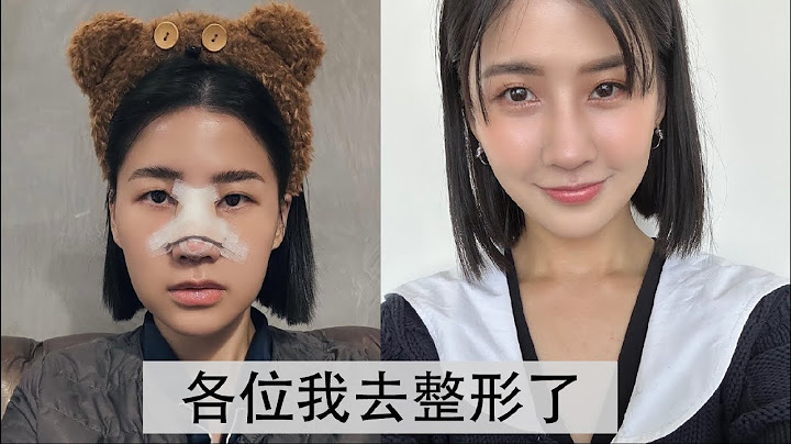 隆鼻手术大公开｜纪录完整术前＆术后心得｜手术总共费用＄ - 天天要闻