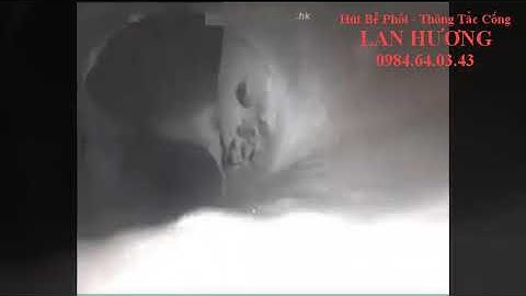 Thông cống nghẹt bằng cách nội soi [Lan Hương]