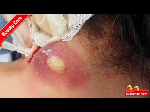 HUGE CYSTIC ACNE EXTRACTION #