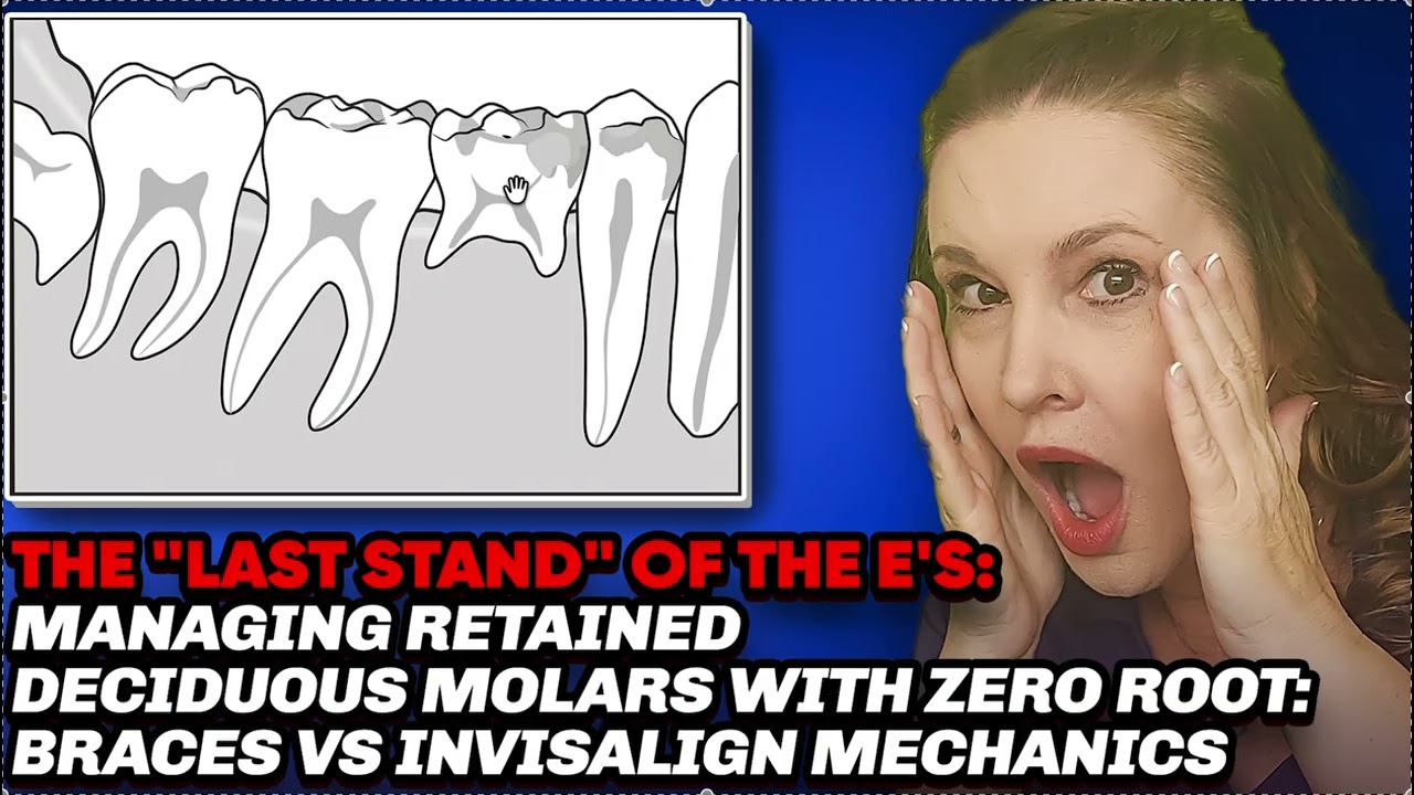 Лечение невылеченных зубов без корней — Манд Болтон, Инвислайн, брекеты, расширители, механика.
