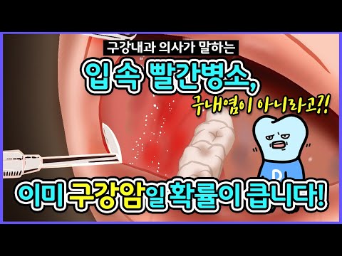 구내염이 아닐수 있습니다. 구강암 초기증상을 의심해야 하는 입병 모음, 구강암 자가진단법 (feat. 홍반증, 적반증, erythroplakia, 구강암 잇몸)