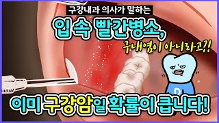 구내염이 아닐수 있습니다. 구강암 초기증상을 의심해야 하는 입병 모음, 구강암 자가진단법 (feat. 홍반증, 적반증, erythroplakia, 구강암 잇몸)