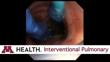 Easy Blocker Placement for Single Lung Ventilation