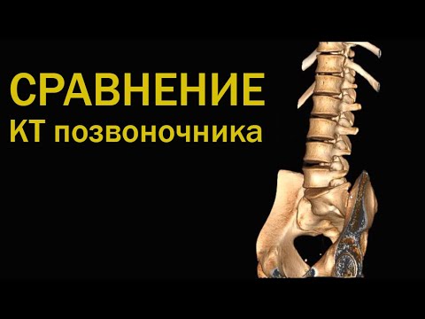 Зачем делать КТ позвоночника / КТ Епифанова разбор