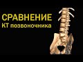 Зачем делать КТ позвоночника / КТ Епифанова разбор