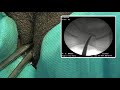 Fluoroscopic technique for Stent Removal in Female