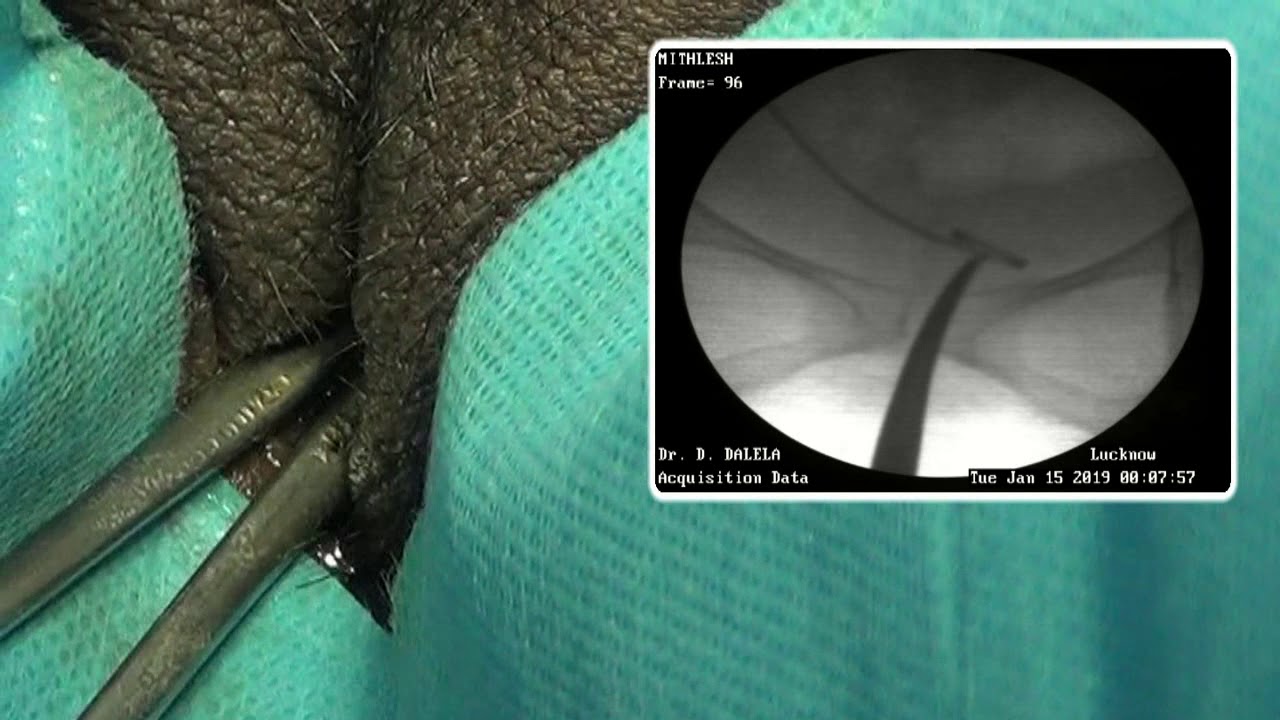video editing software free Fluoroscopic technique for Stent Removal in Female