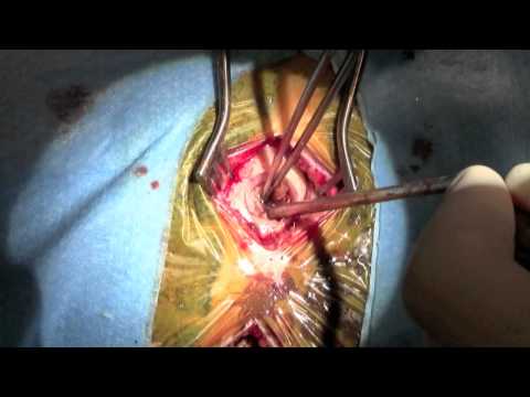 Video: Burr Hole: Klady A Zápory Chirurgického Zákroku