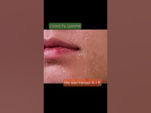 Ознаки дефіциту вітамінів - YouTube