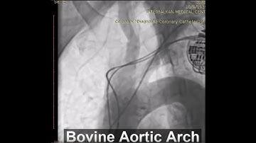 A step by step TAVI using Portico FlexNav system