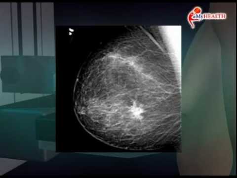 Video: Sakit Mamogram? Bagaimana Rasanya Dan Apa Yang Harapan Selepas