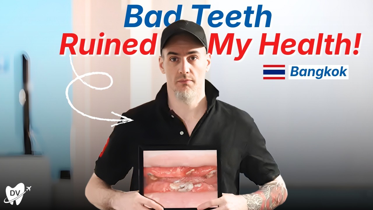 Dental Veneers Gone Wrong? How All-on-4 Dental Implants Fixed His Smile in Bangkok