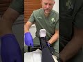 Dr. Steinke explains how to properly apply an ankle brace to an injured foot