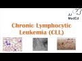 Chronic Lymphocytic Leukemia (CLL): Symptoms (ex. Skin Blisters), Diagnosis and Treatment (Vit D?)