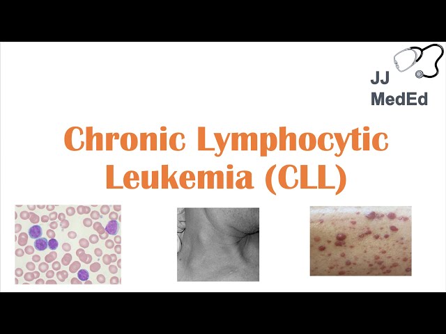 Chronic Lymphocytic Leukemia (CLL): Symptoms (ex. Skin Blisters), Diagnosis and Treatment (Vit D?) class=