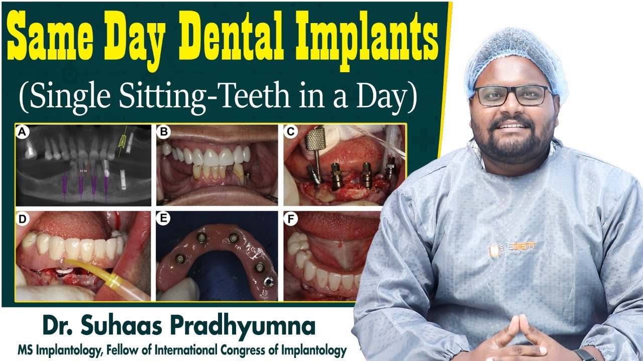 What is Immediate Dental Implant Placement Dental Implants in One Day