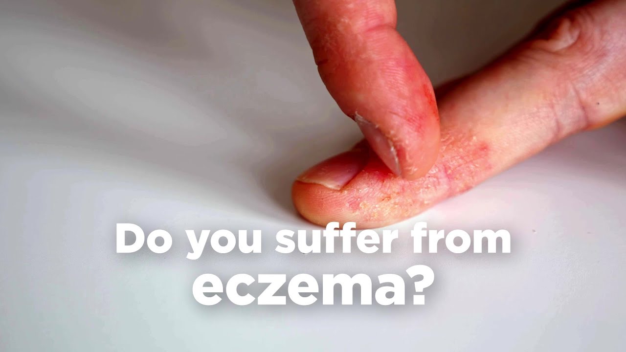 Key nutrients that may help treat eczema