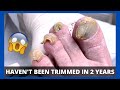 CUTTING AND GRINDING CRAZY TOENAILS - Toe Fungus Journey
