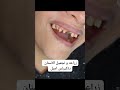 زراعه و تجميل الاسنان دكتور كيرلس اميل 