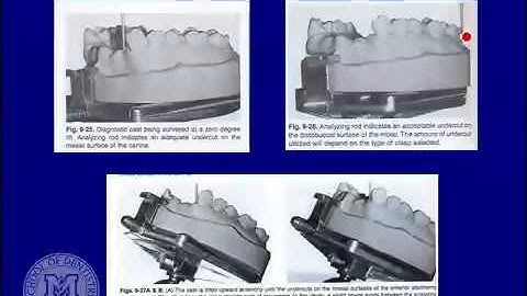 DENT 718: Rotational path partial dentures