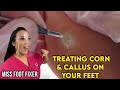 Treatment Of Hard Skin Callus and Corn on Your Feet by Famous Podiatrist Miss Foot Fixer
