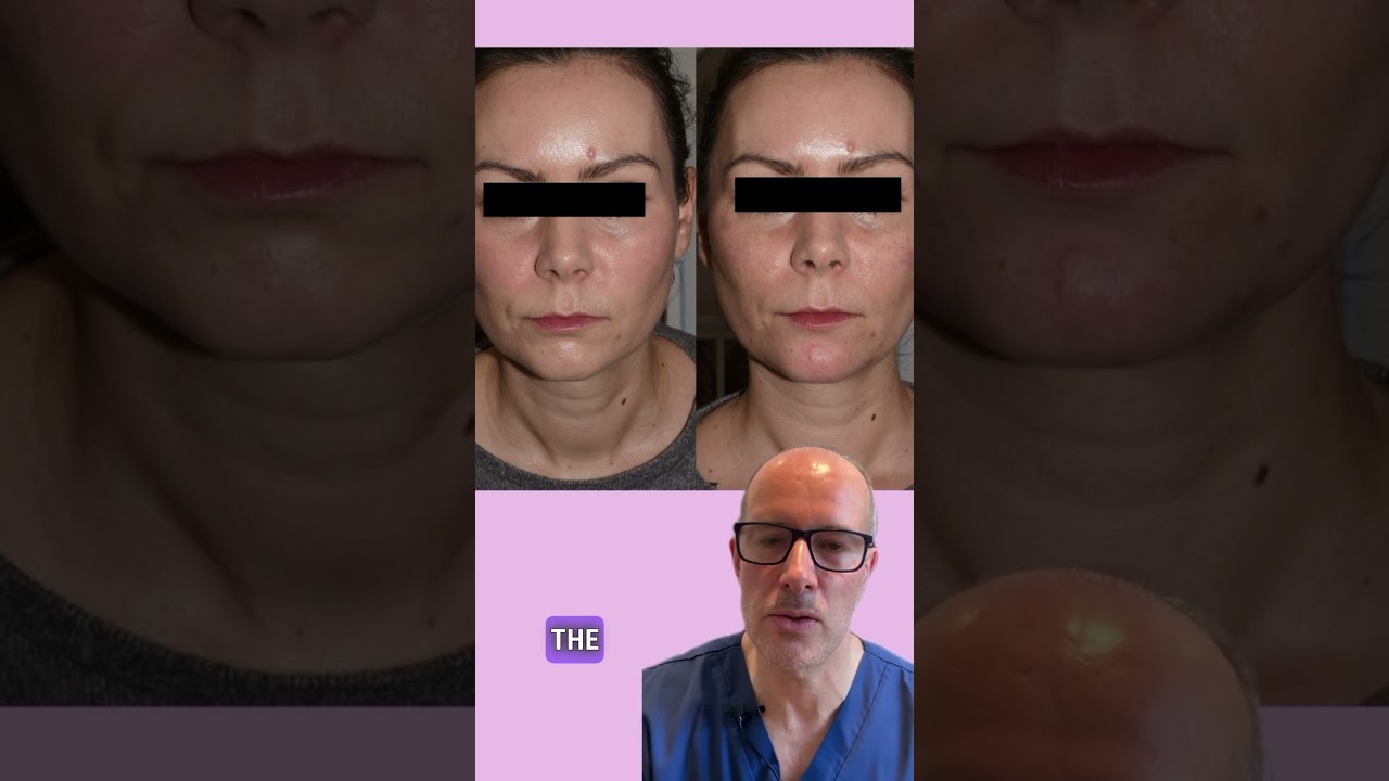 Subtle Yet Stunning: Cheek and Chin Filler Transformation | Busting Filler Myths