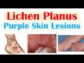 Lichen Planus (“Purple Skin Lesions”) | Causes, Signs & Symptoms, Diagnosis, Treatment