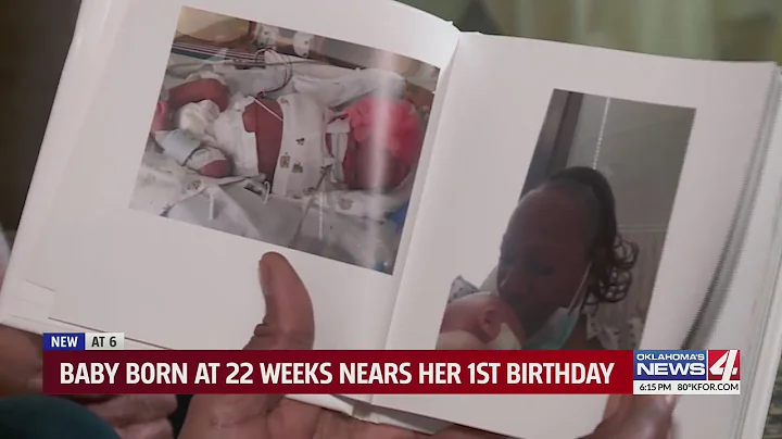 Baby born at 22 weeks nears her 1st birthday
