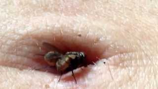 Navel Attacked By Flies Navel Attacked By Flies