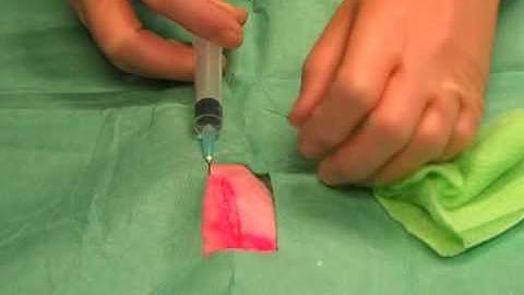 Suturing: 1 Infiltrating local anaesthetic