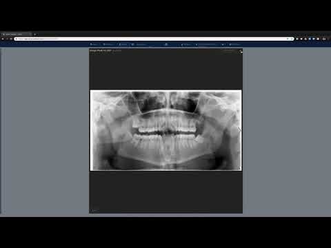 axiUm Ascend - Chart Image Peek and Filtering by Tooth Selected