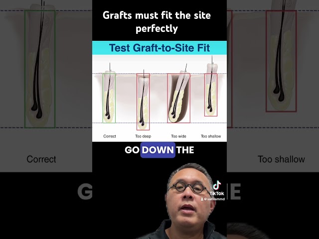 Grafts must fit the site perfectly #dallashairtransplant
