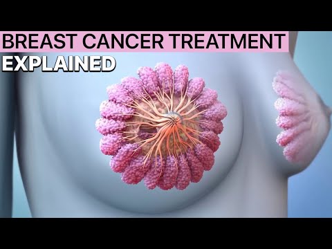 Breast Cancer Treatment Explained by a Surgeon