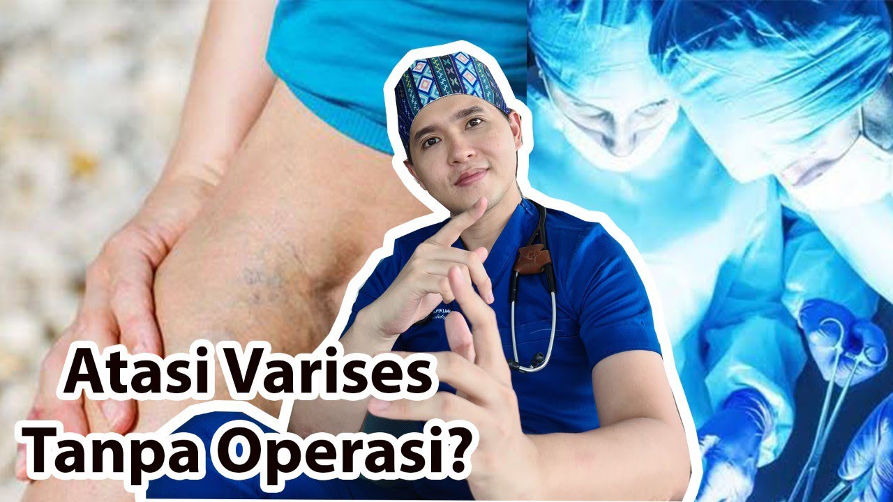 MENGATASI VARISES TANPA OPERASI