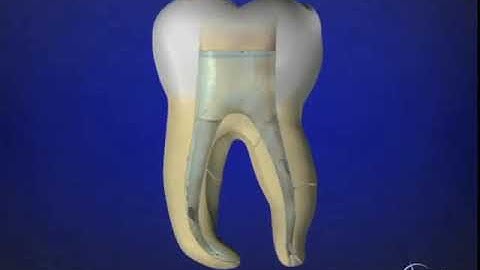 Shape Clean Pack: 3D Obturation: Carrier Based Obturation: Dr. Ruddle Advanced Endodontics