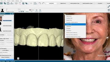 How to make porcelain veneers using Nemo Smile? Mock-up for veneers and digital smile design.