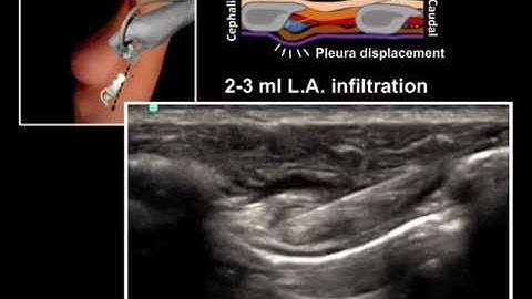 ULTRASOUND GUIDED INTERCOSTAL NERVE BLOCK
