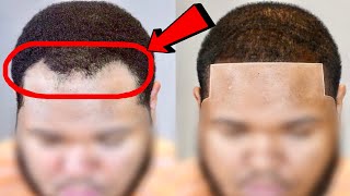 AMAZING Hairline Transformation. RECEDING Hairline Restoration